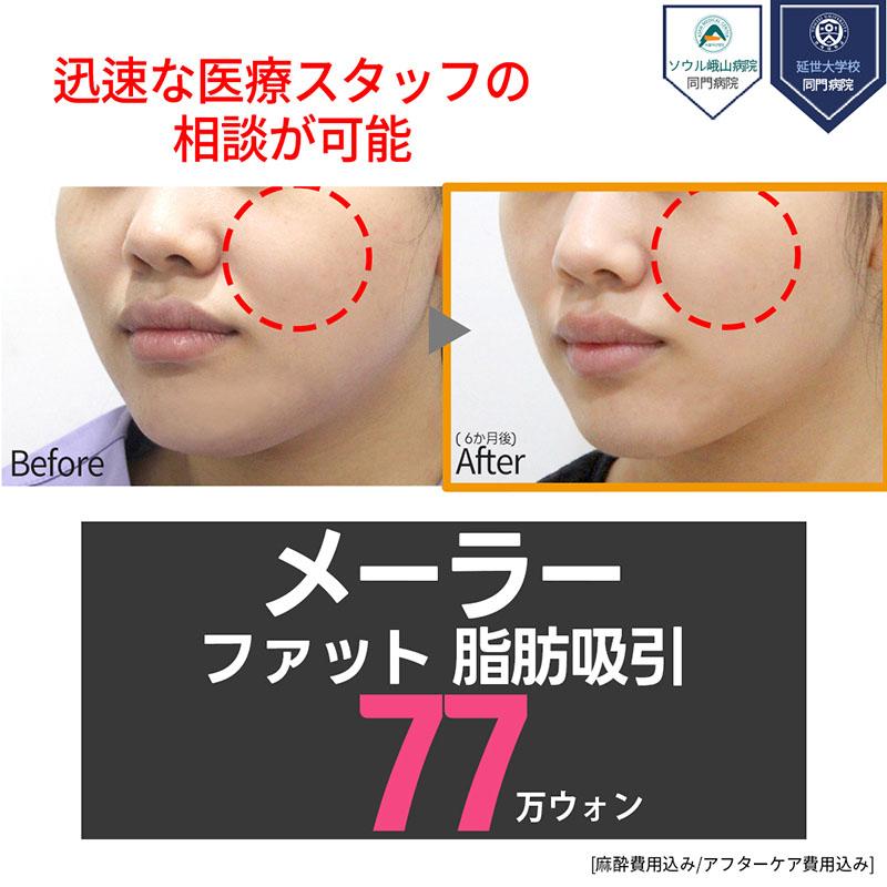 顔の脂肪吸引_メーラーファット