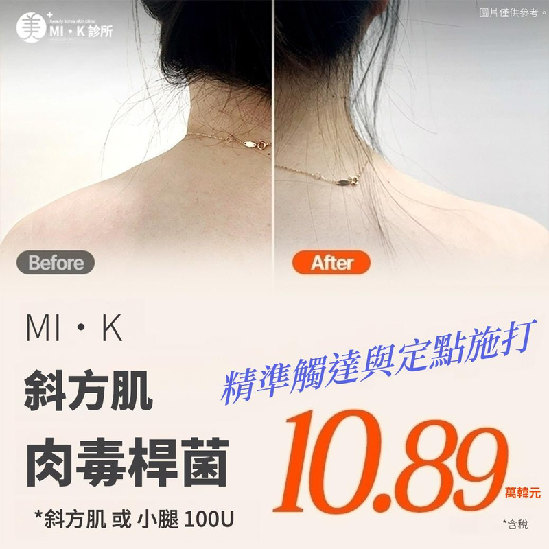 美凱 斜方肌&小腿肉毒桿菌 100U