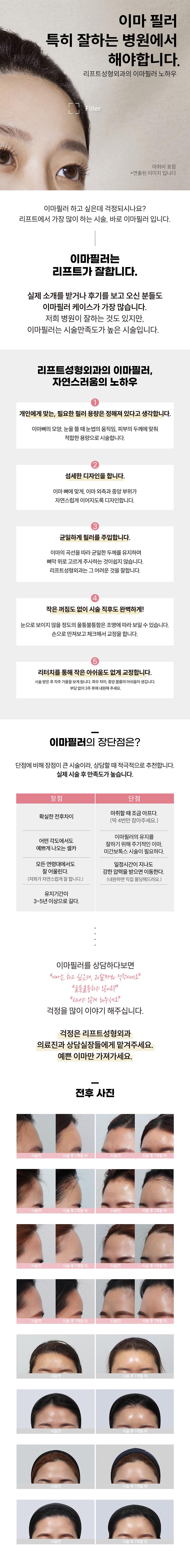 대구 동성로 리프트성형외과의 15만원 이마필러 시술로 자연스러운 입체감과 부드러운 곡선 완성