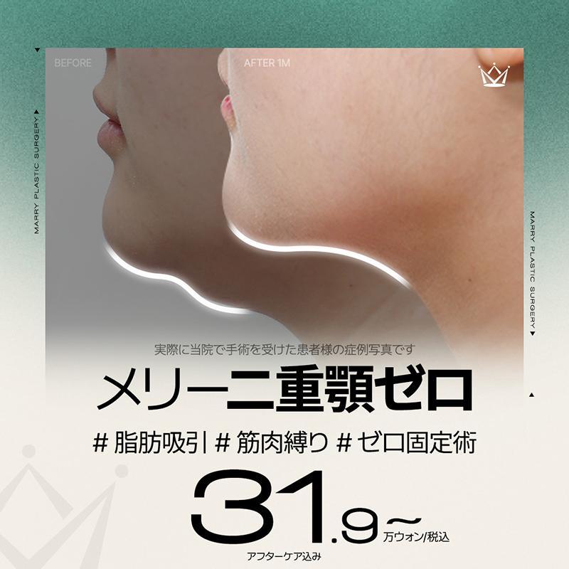 二重顎ゼロ 脂肪吸引