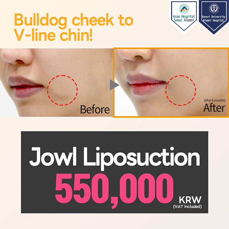 Jowl Fat Liposuction
