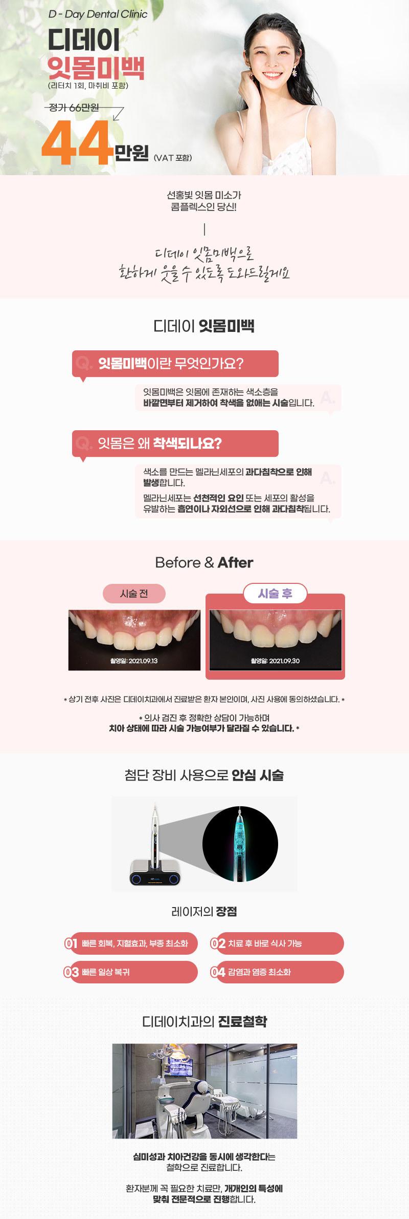 서울 선릉 디데이치과의원의 잇몸미백 시술로 거뭇거뭇한 잇몸을 하얗게 개선하는 44만원 특가 프로모션