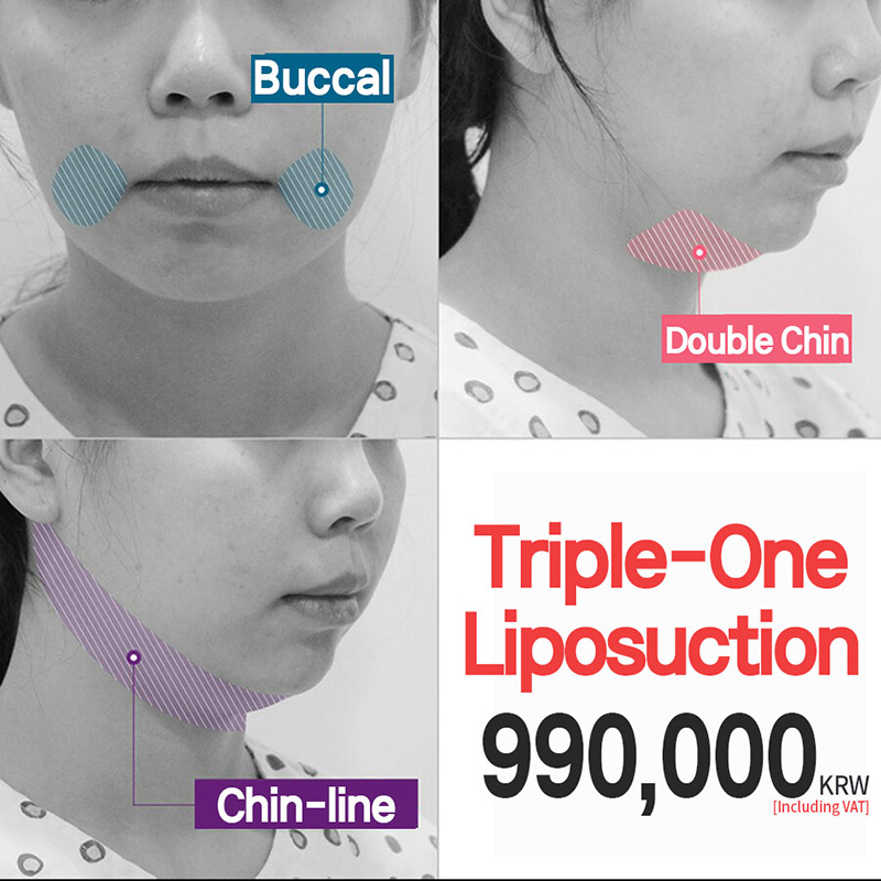 Triple-One Liposuction