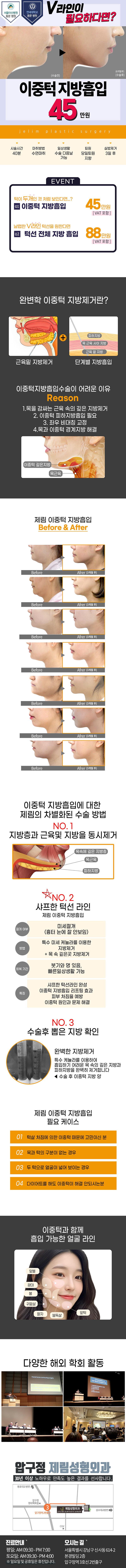 제림성형외과의원의 이중턱 지방 빼고 V라인 성형 시술로 얼굴의 이중턱과 턱선의 지방을 제거하여 V라인을 만들어 드립니다.