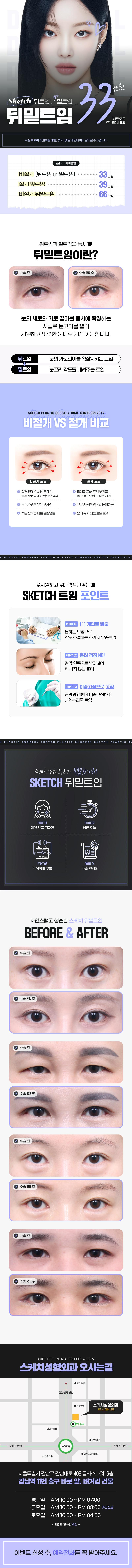 강남역 스케치성형외과의 비절개 듀얼트임 시술로 시원하고 또렷한 눈매 완성 (33만원)