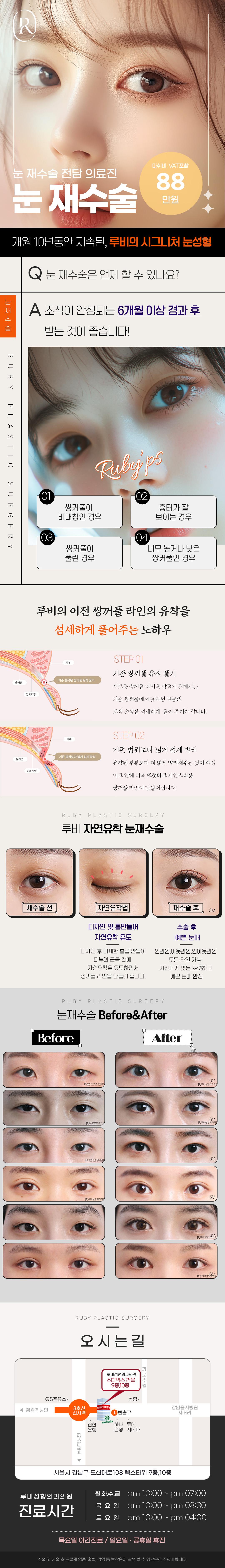 서울 신사동 루비성형외과의 눈재수술 88만원 특가 프로모션 (마취비/부가세 포함)