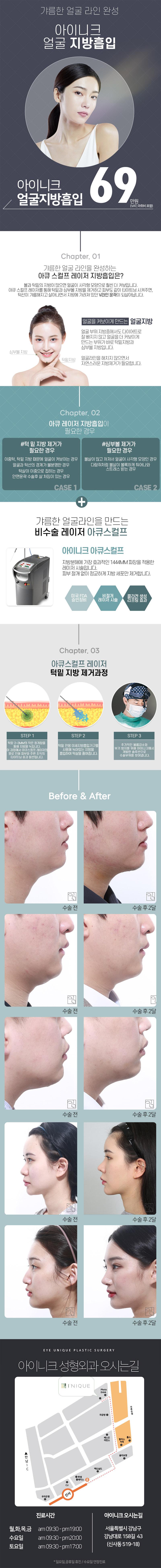 아이니크성형외과의 얼굴지방흡입 시술로 갸름한 V라인 얼굴 완성 (69만원 특가)