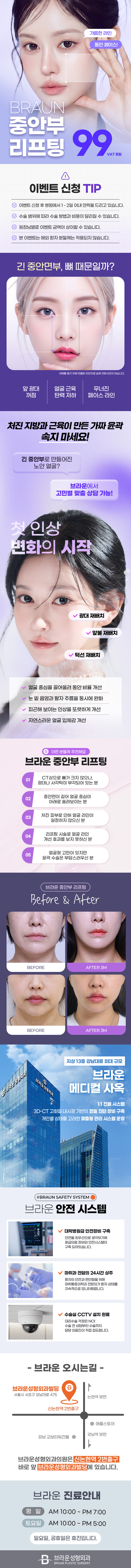 브라운성형외과의원에서 제공하는 브라운 중안부리프팅 중안부축소 서비스