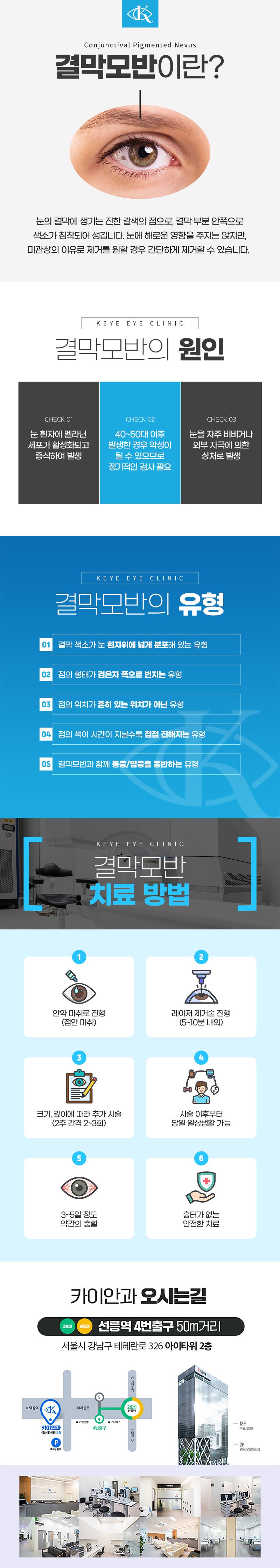 서울 선릉 카이안과의원의 결막모반 제거술 - 눈의 결막 색소침착 및 점을 제거하는 15만원 시술