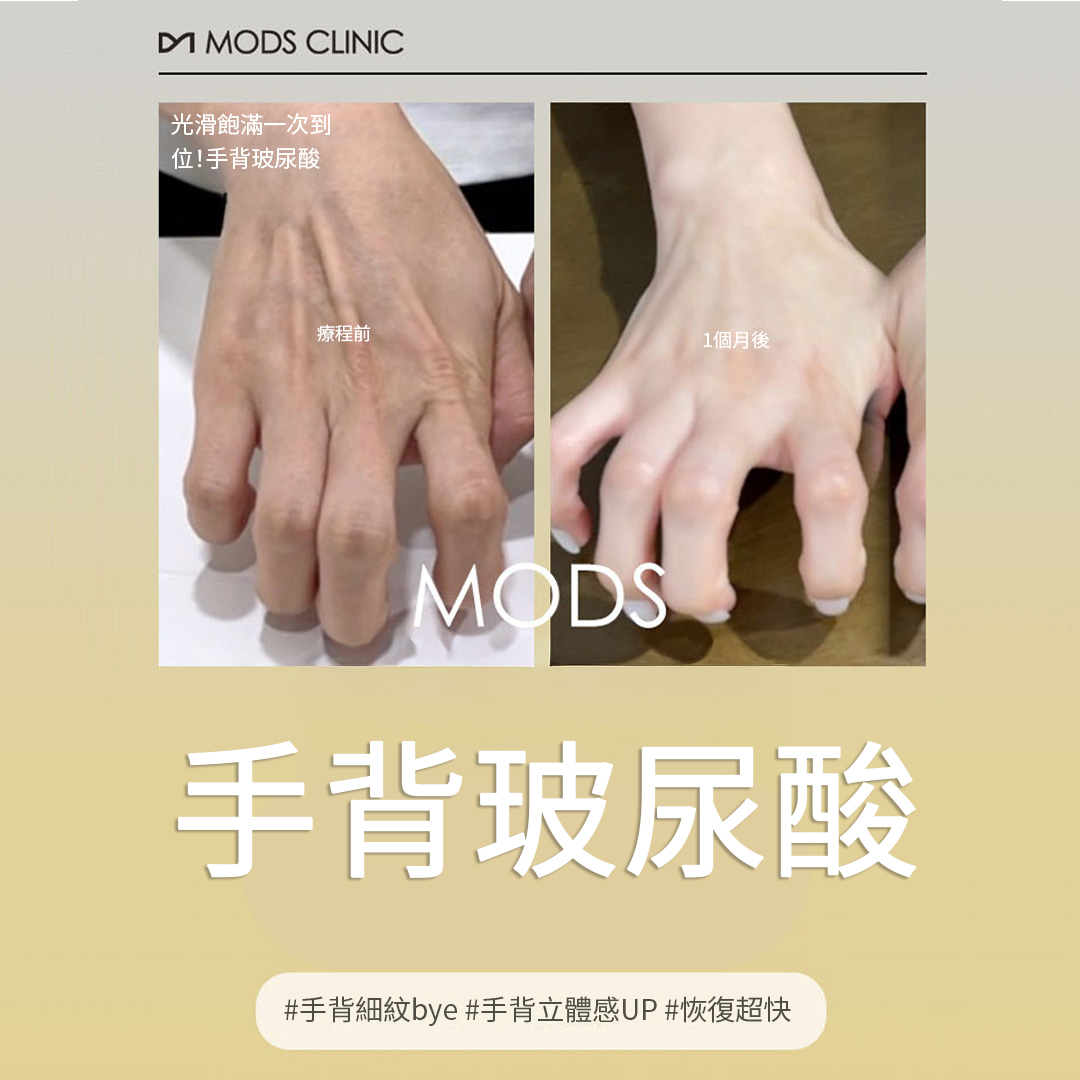 清潭 Mods 無異物感手背玻尿酸填充