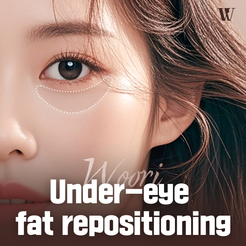 Orbital Septum Reinforcement Under-Eye Fat Repositioning