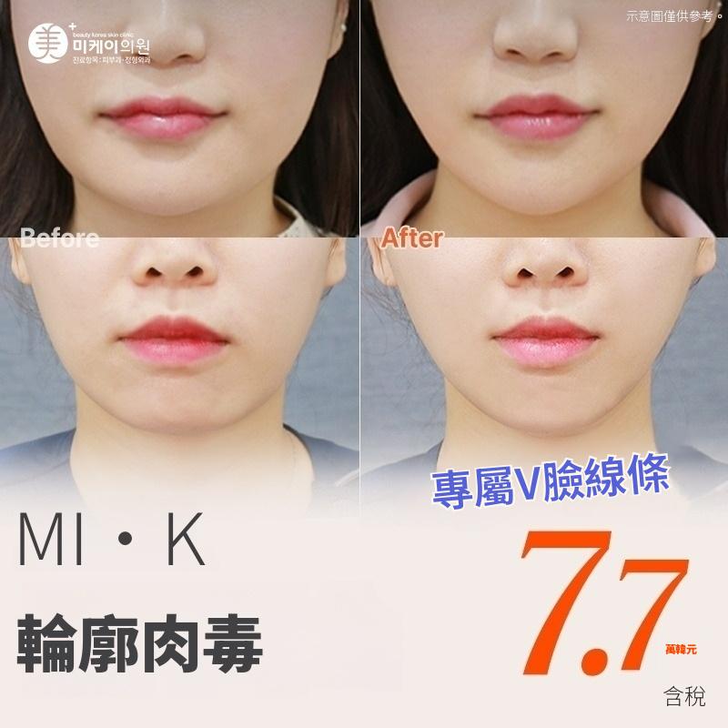 米凱 V臉線條輪廓肉毒