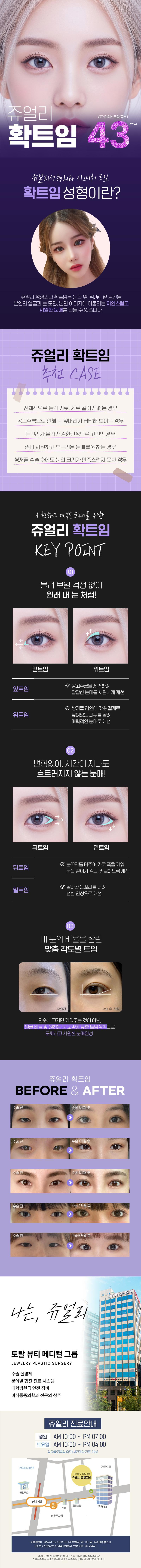 서울 신사동 쥬얼리성형외과의 43만원 FULL 확트임 성형 패키지 (앞/뒤/위/밑 전체 트임)