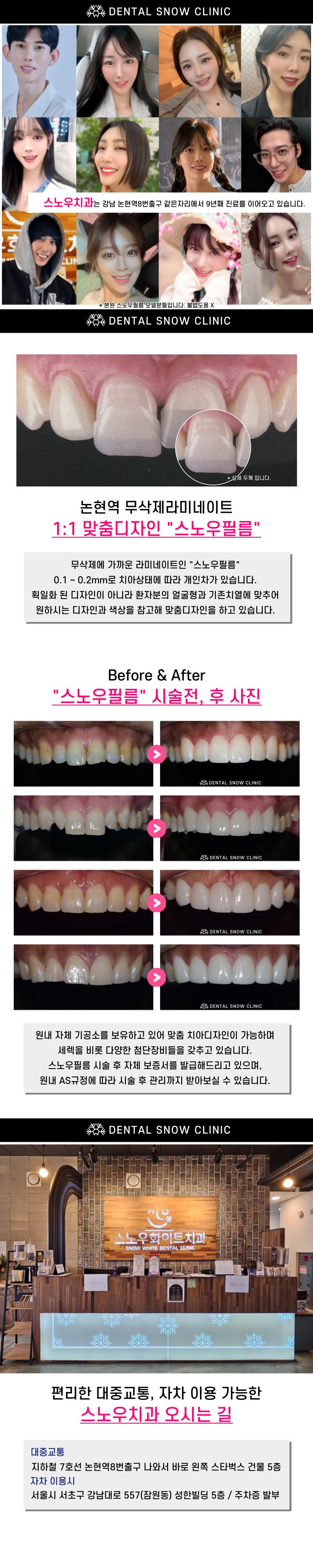 스노우치과의원의 무삭제 라미네이트 '스노우필름' 여름 이벤트 진행 (29만원)