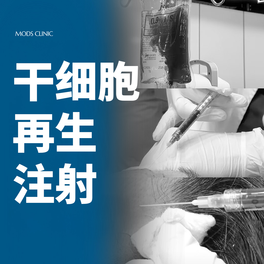 清潭MODS干细胞注射