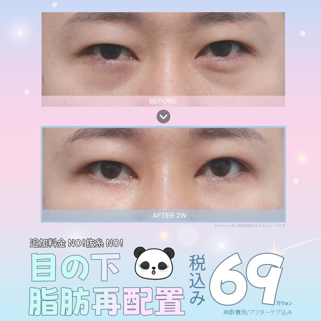 目の下 キラパンダ整形