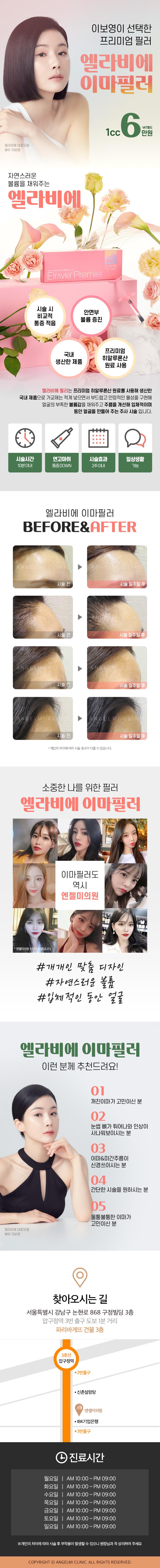 압구정 엔젤미의원의 엘라비에 이마필러 시술 - 자연스러운 이마 볼륨 개선, 1cc 6만원 특가