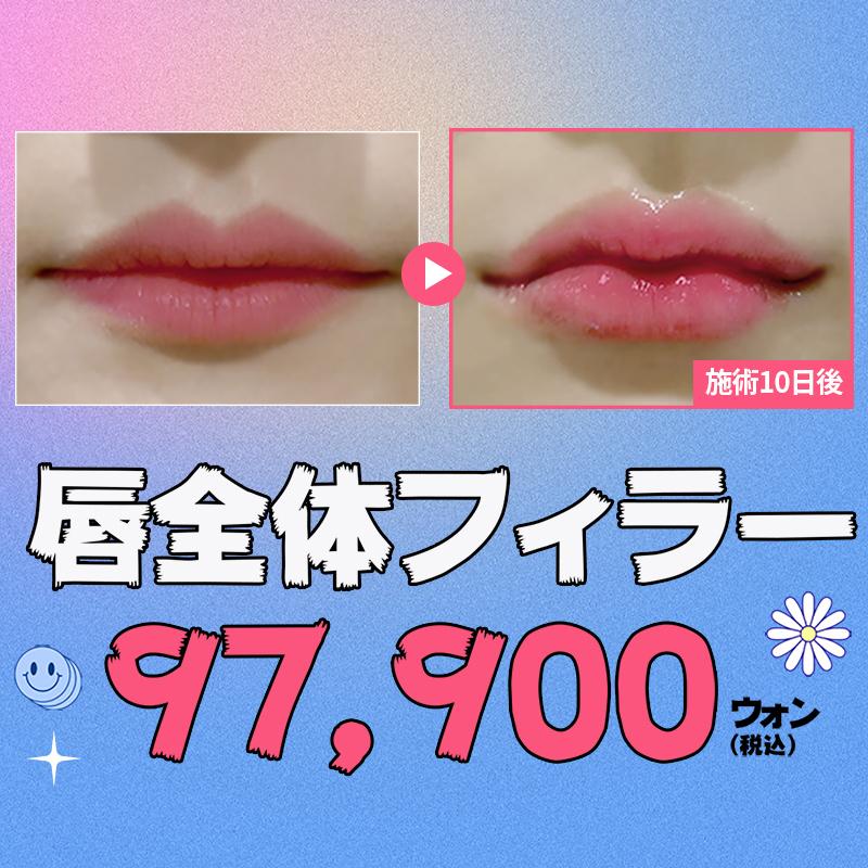 唇全体フィラー
