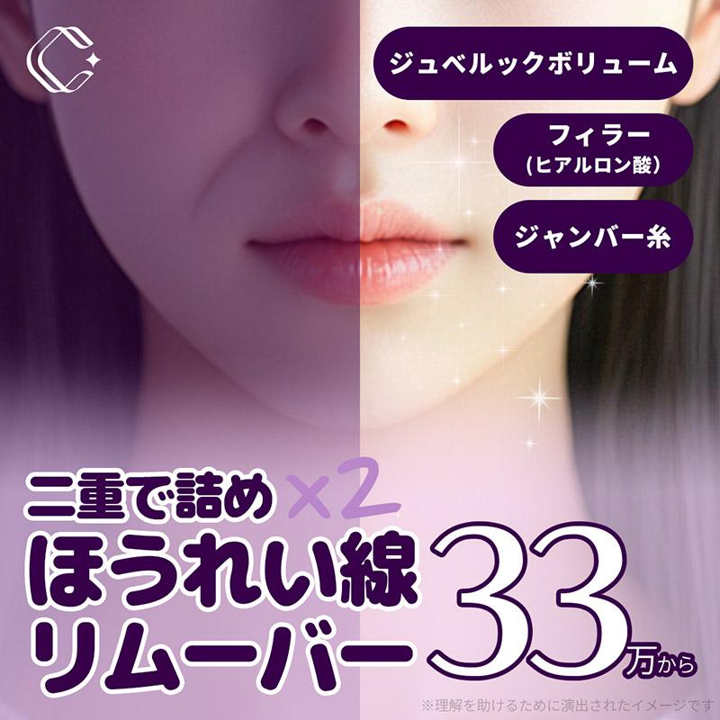 二重で詰め _ほうれい線リムーバー,ほうれい線_フィラー（ヒアルロン酸）_ジュベルック-ボリューム,ジャンバー糸_糸リフティング