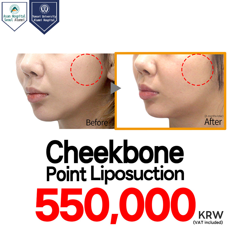 Cheekbone Point Liposuction