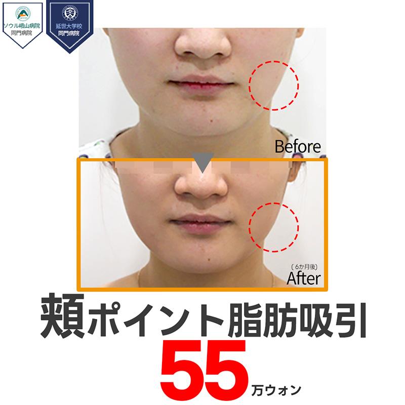 顔の脂肪吸引_頬ポイント脂