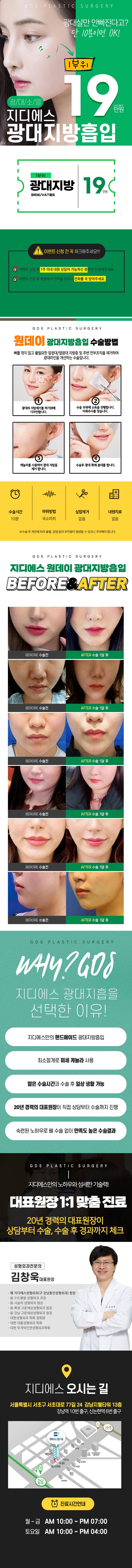 서울 신논현 지디에스성형외과의 19만원 원데이 광대지방흡입 시술 홍보