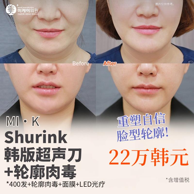 米凯 Shurink韩版超声刀 & 轮廓瘦脸针
