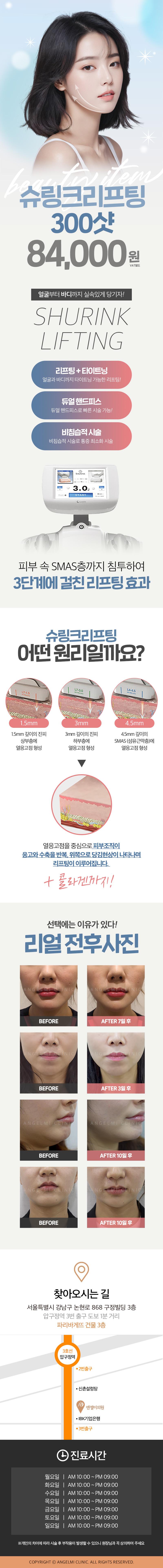 압구정 엔젤미의원의 슈링크 리프팅 300샷 특가 프로모션 - V라인 개선 시술 84,000원