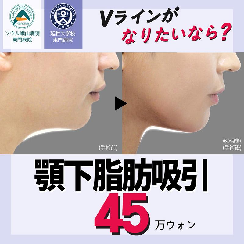 顔の脂肪吸引_顎下脂肪を除いてVライン