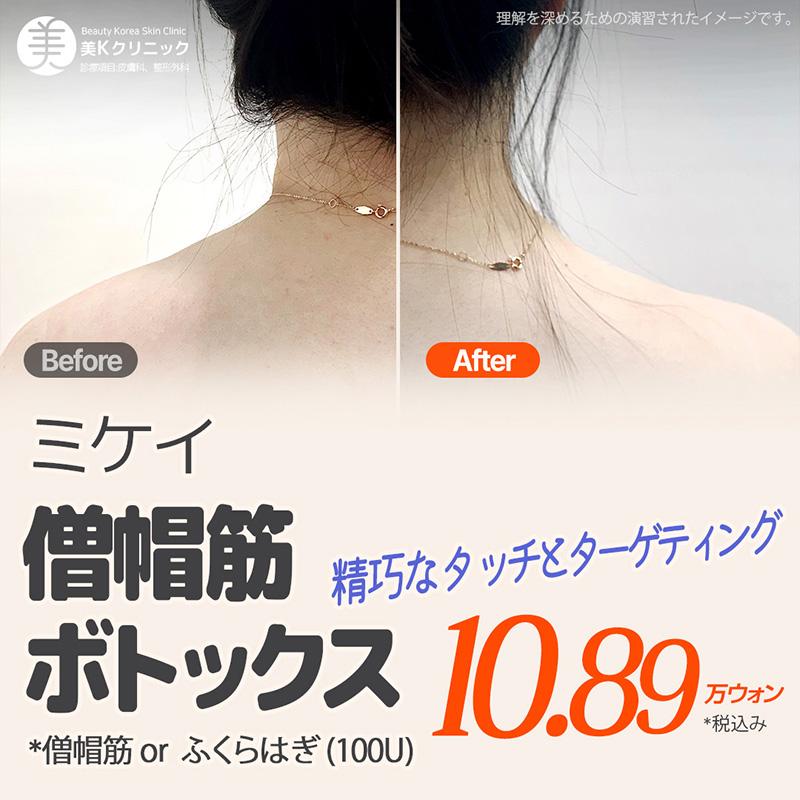 美K 僧帽筋&ふくらはぎ ボトックス