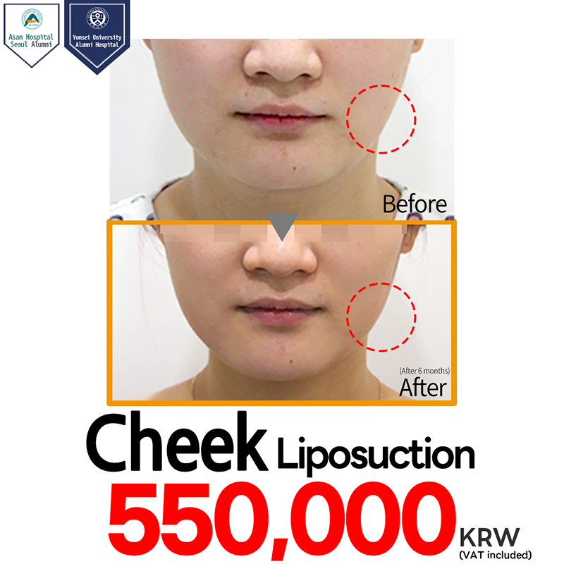Cheek Liposuction