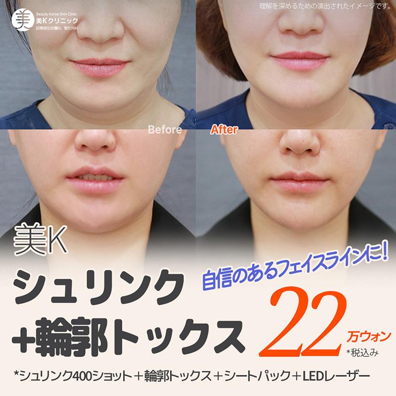 美Kシュリンク＋輪郭トックス