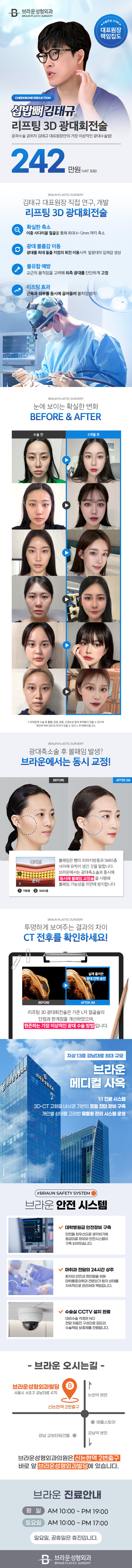 브라운성형외과의원에서 제공하는 브라운 김태규 광대축소 서비스