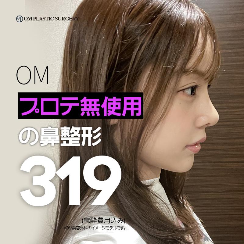 自然な仕上がりのプロテーゼなし鼻整形イベント