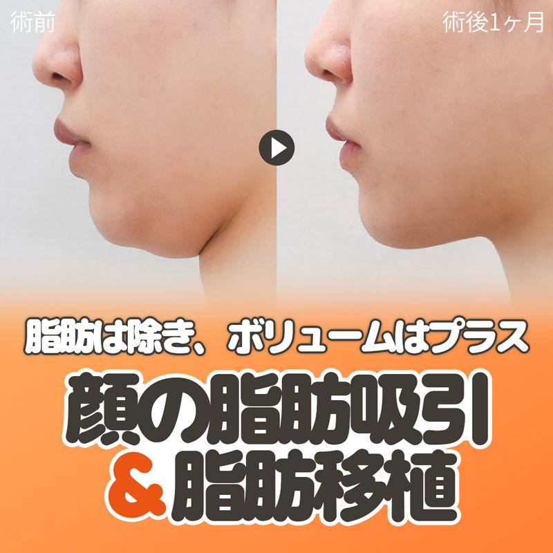 クレア 顔の脂肪吸引 筋肉縛り 脂肪移植