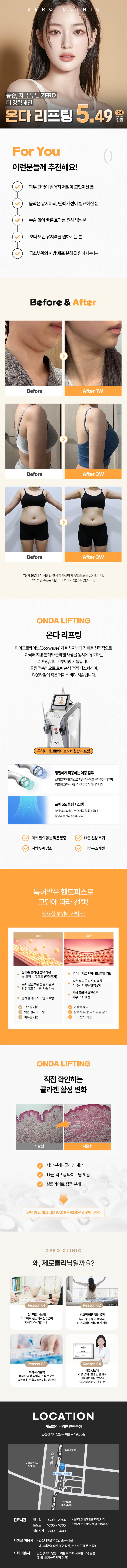 제로의원(인천점)에서 제로 온다 레이저리프팅 진행 - 높은 시술효과와 지속력을 원하는 분, 안전한 리프팅을 원하는 분, 리프팅+타이트닝 개선을 원하는 분을 대상으로 합니다.