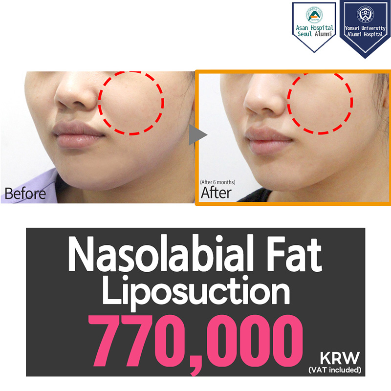 Nasolabial Liposuction
