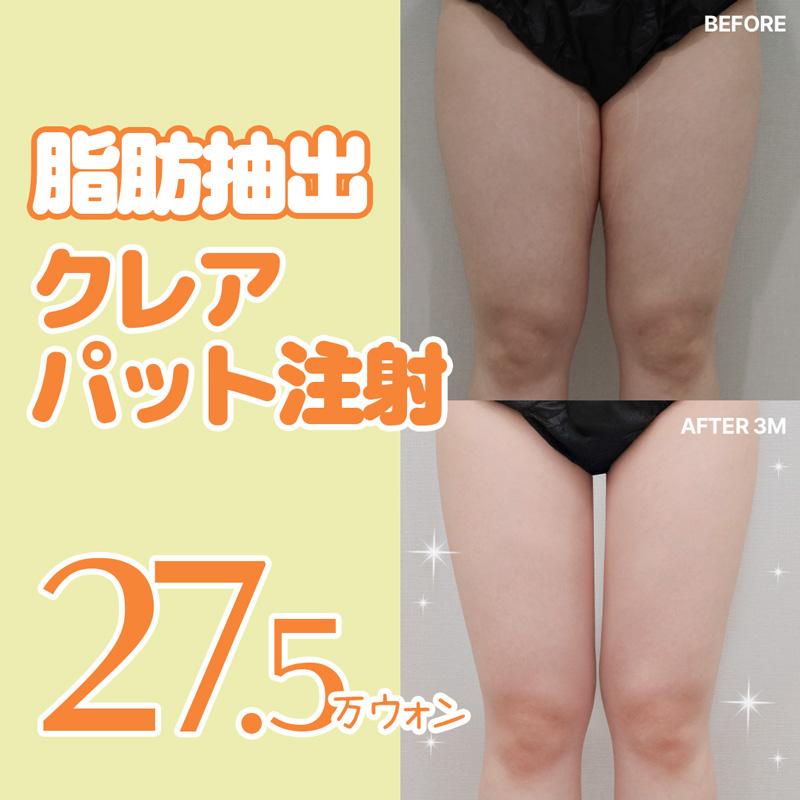 クレア パット注射_脂肪抽出_脂肪溶解注射_脂肪吸引注射_太もも_二の腕