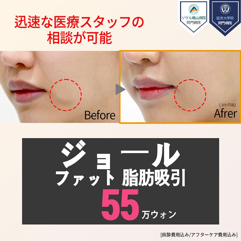 顔の脂肪吸引_ジョールファット除去