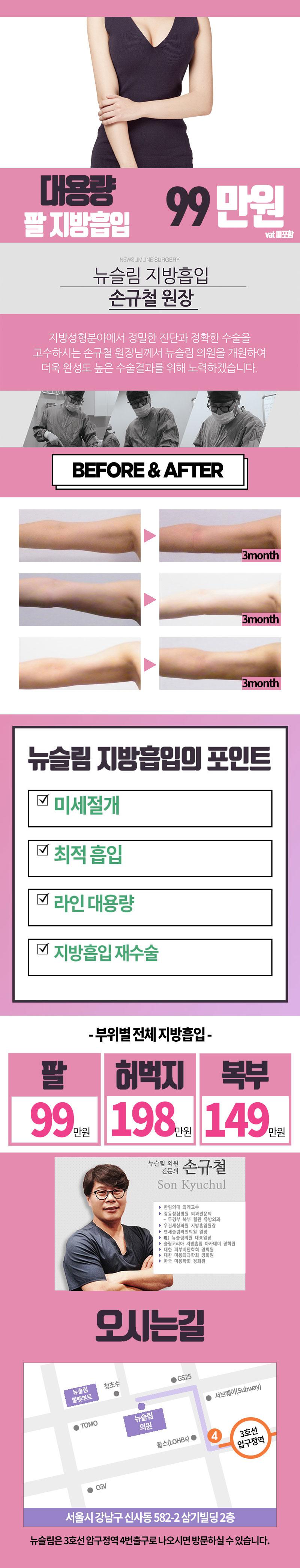 서울 압구정 뉴슬림의원의 99만원 대용량 팔 지방흡입 시술 프로모션