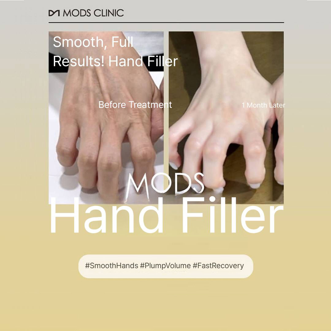 Cheongdam Mod's Hand Dorsum Filler with No Foreign Body Sensation
