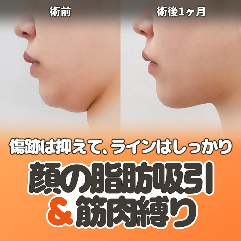 クレア 顔の脂肪吸引&筋肉縛り