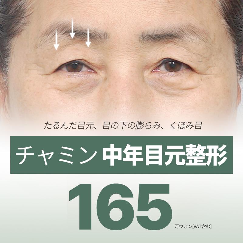 チャミン　中年目元整形