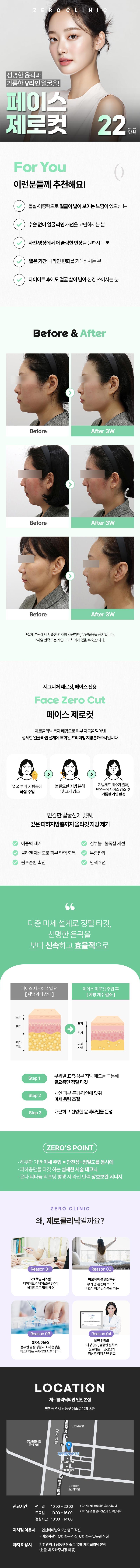 제로의원 인천점에서 제공하는 얼굴 윤곽 지방분해주사는 이중턱과 얼굴 지방을 효과적으로 관리하는 시술입니다.