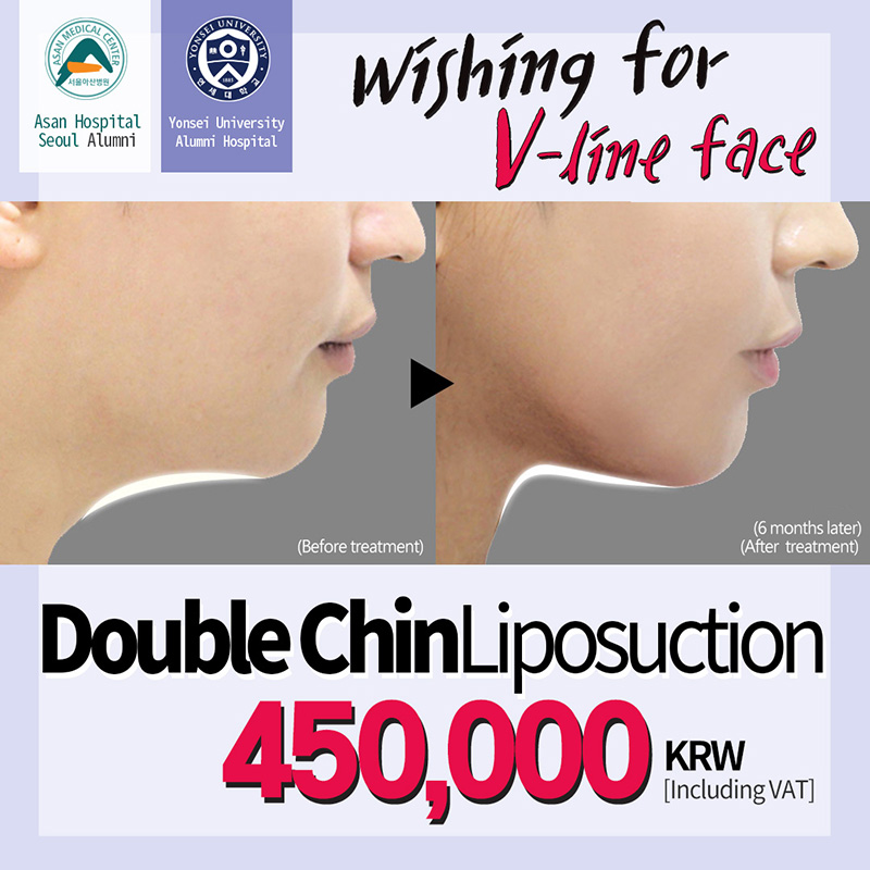 Double Chin Liposuction
