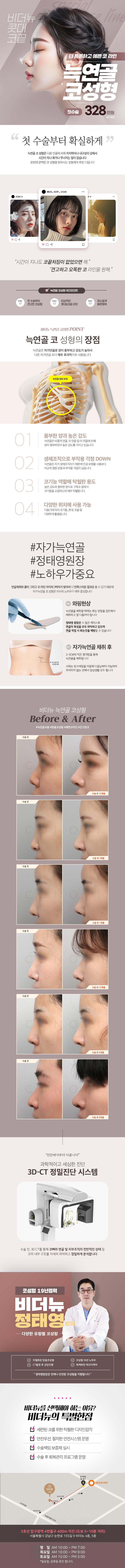 비더뉴의원의 늑연골 코성형은 서울 압구정에서 제공되며, 328만원에 첫코수술을 한번으로 끝내고 싶은 분과 코끝 처짐 없는 코성형을 원하시는 분들을 위한 특화된 시술입니다.