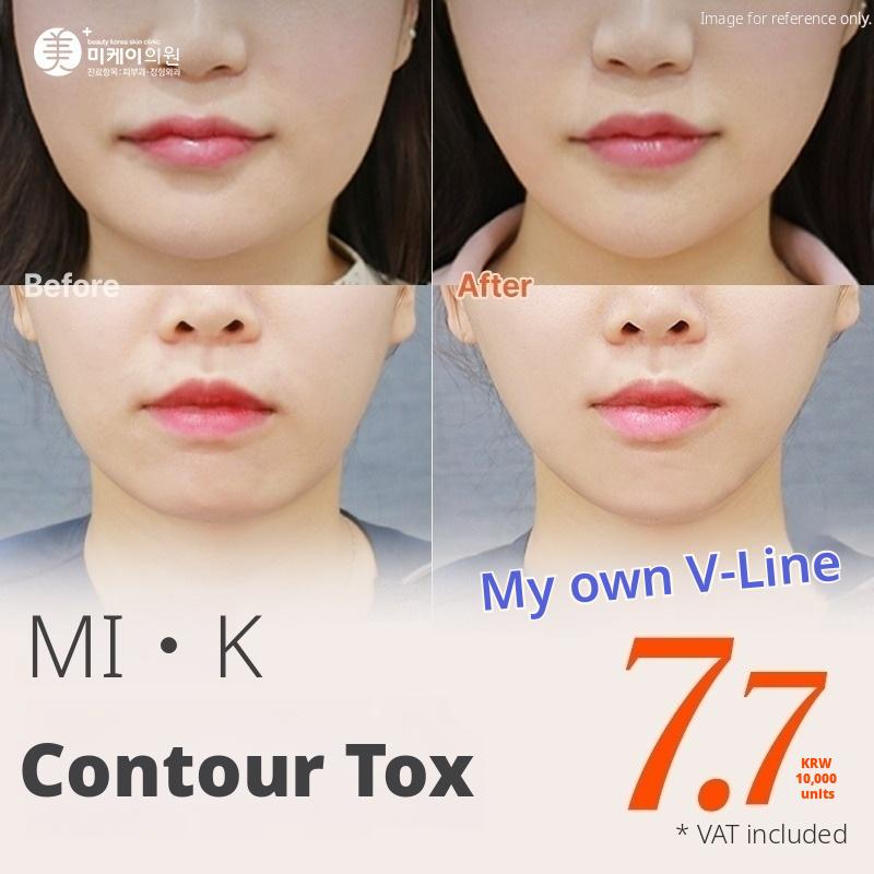 MI.K V-Line Contour Botox