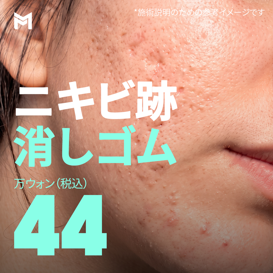 ニキビ跡消しゴム ミラジェット＆ジュベルック