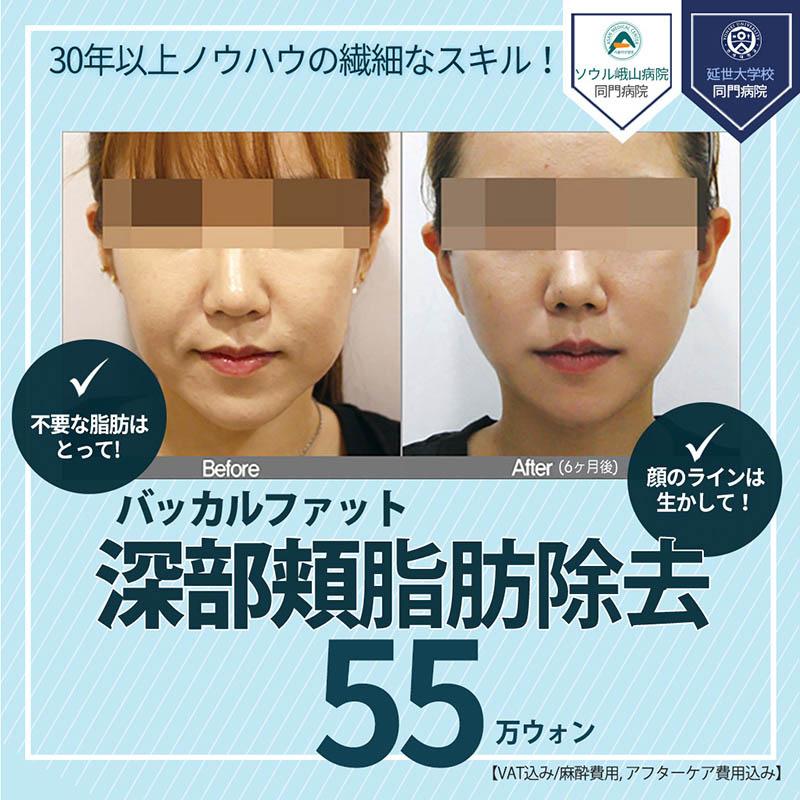 顔の脂肪吸引_深部頬脂肪除去