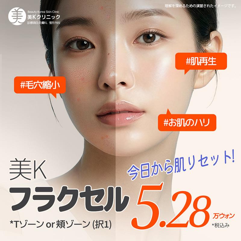 美K 毛穴&ニキビ跡 卵肌に_フラクセル